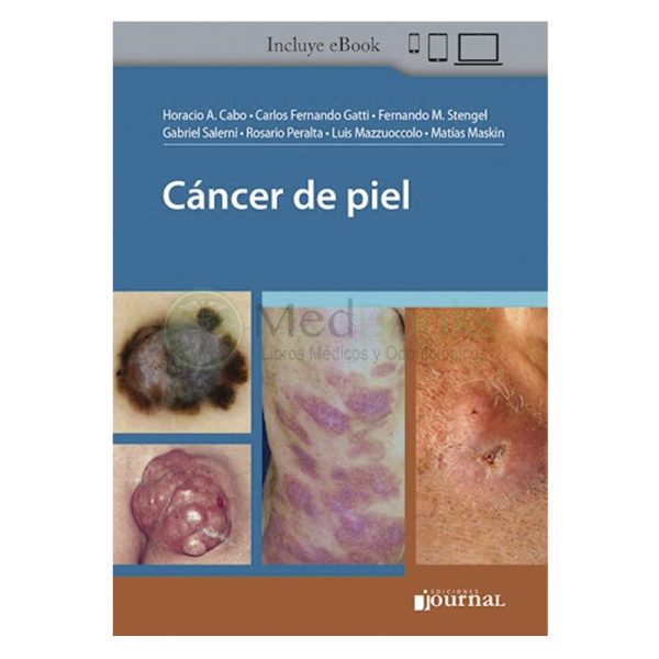 Cáncer de piel