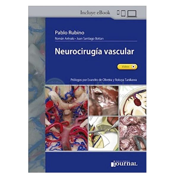 Neurocirugía Vascular