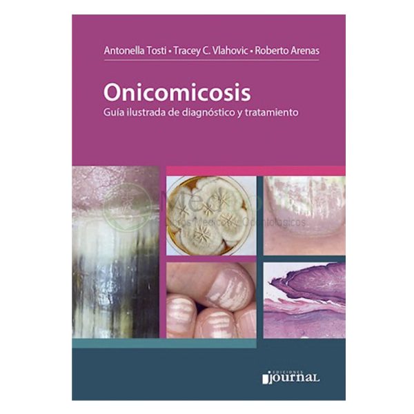 Onicomicosis
