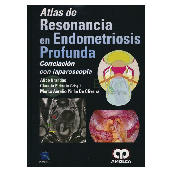 Atlas de Resonancia en Endometriosis Profunda. Correlación con Laparoscopia