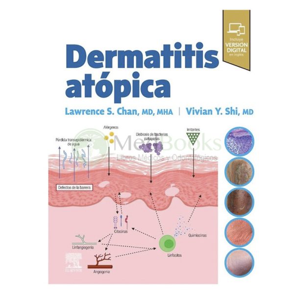 DERMATITIS ATÓPICA