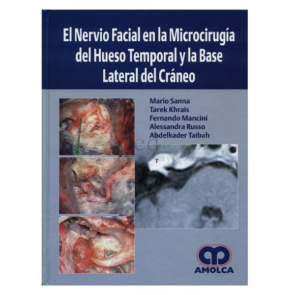 El Nervio Facial en la Microcirugía del Hueso Temporal y la Base Lateral del Craneo