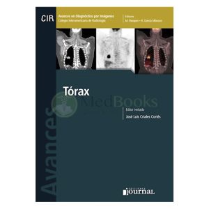 Avances en Diagnóstico por Imágenes: Tórax (eBook)