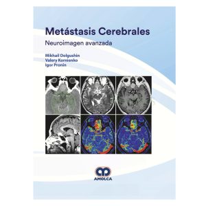 Metástasis Cerebrales. Neuroimagen Avanzada