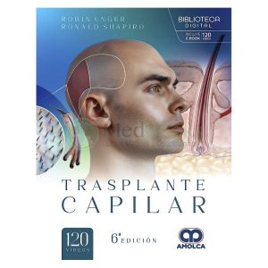 Trasplante Capilar