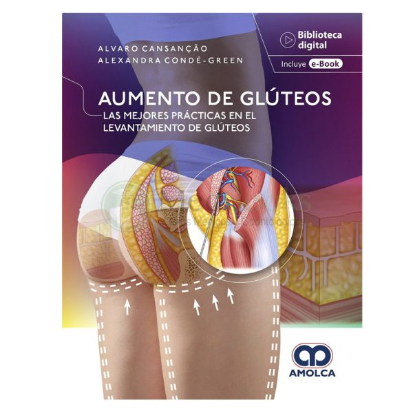 Aumento de Glúteos. Las Mejores Prácticas en el Levantamiento de Glúteos