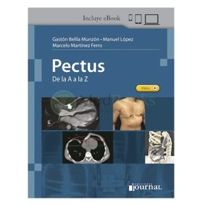Pectus De la A a la Z